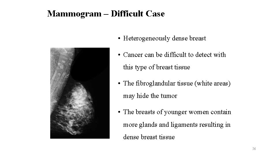 Mammogram – Difficult Case • Heterogeneously dense breast • Cancer can be difficult to