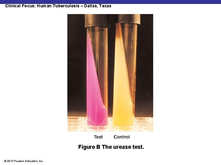 Clinical Focus: Human Tuberculosis – Dallas, Texas Figure B The urease test. © 2013