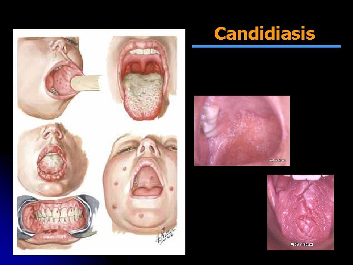 Candidiasis 