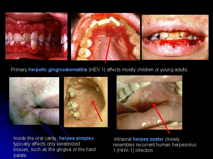 Primary herpetic gingivostomatitis (HEV 1) affects mostly children or young adults. Inside the oral