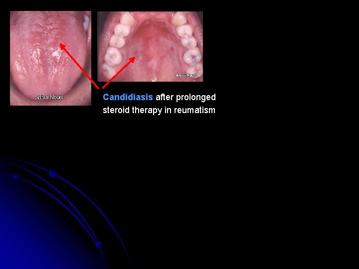 Candidiasis after prolonged steroid therapy in reumatism 