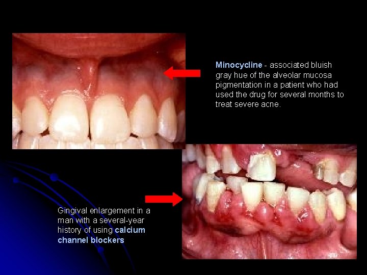 Minocycline - associated bluish gray hue of the alveolar mucosa pigmentation in a patient