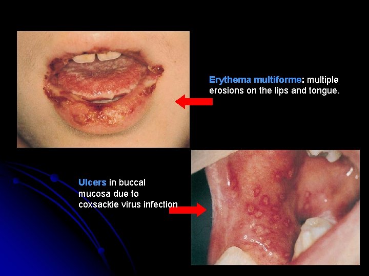 Erythema multiforme: multiple erosions on the lips and tongue. Ulcers in buccal mucosa due