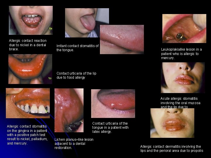 Allergic contact reaction due to nickel in a dental brace. Irritant contact stomatitis of