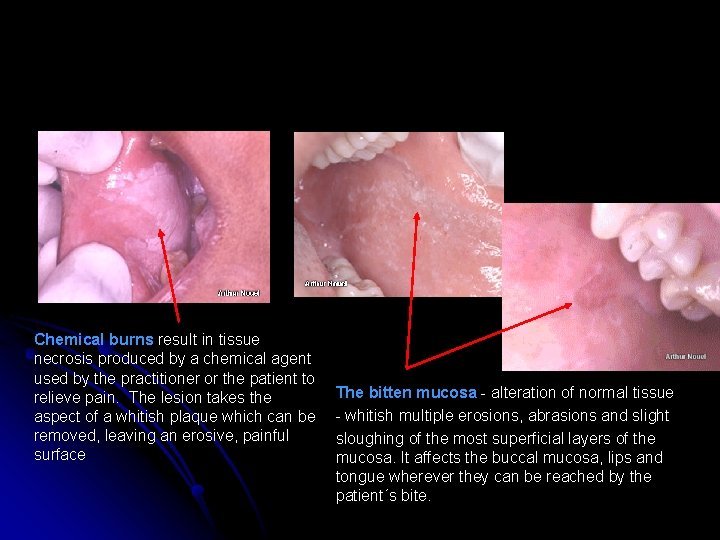 Chemical burns result in tissue necrosis produced by a chemical agent used by the