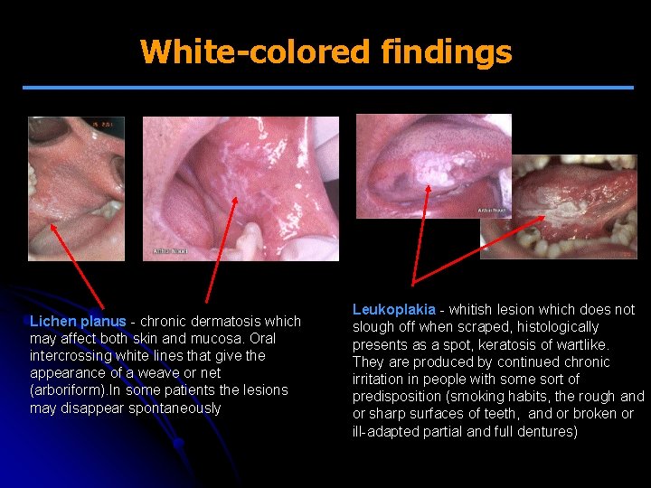 White-colored findings Lichen planus - chronic dermatosis which may affect both skin and mucosa.