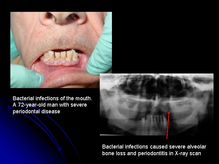 Bacterial infections of the mouth. A 72 -year-old man with severe periodontal disease Bacterial