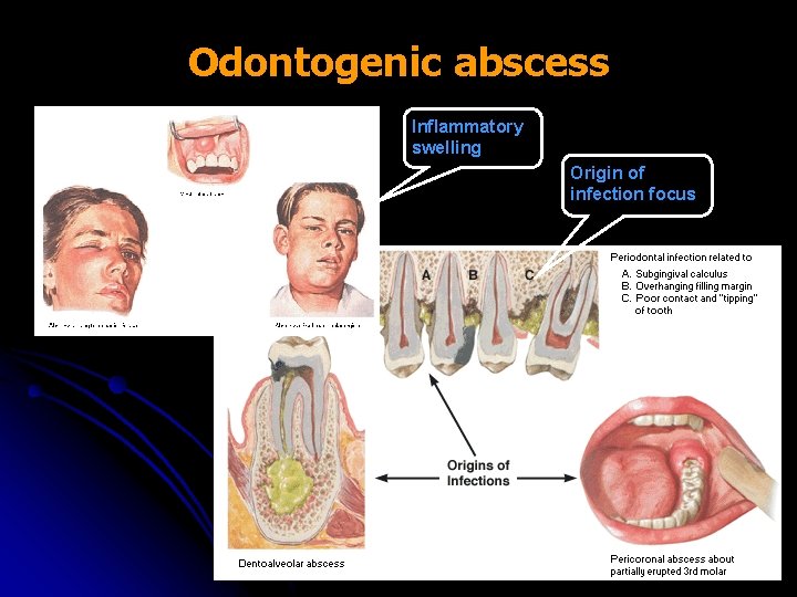Odontogenic abscess Inflammatory swelling Origin of infection focus 