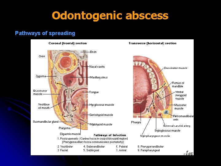 Odontogenic abscess Pathways of spreading 