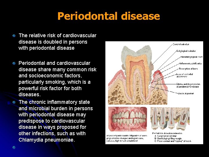 Periodontal disease The relative risk of cardiovascular disease is doubled in persons with periodontal