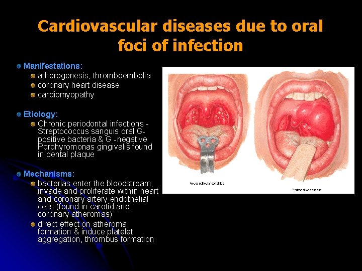 Cardiovascular diseases due to oral foci of infection Manifestations: atherogenesis, thromboembolia coronary heart disease