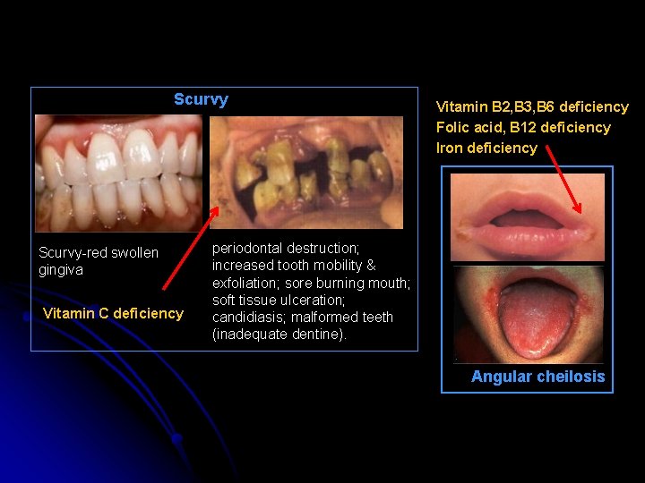 Scurvy-red swollen gingiva Vitamin C deficiency Vitamin B 2, B 3, B 6 deficiency