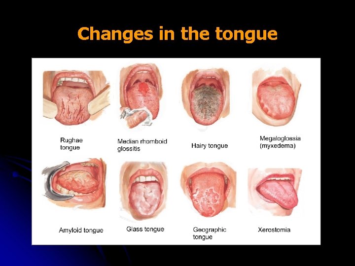 Changes in the tongue 