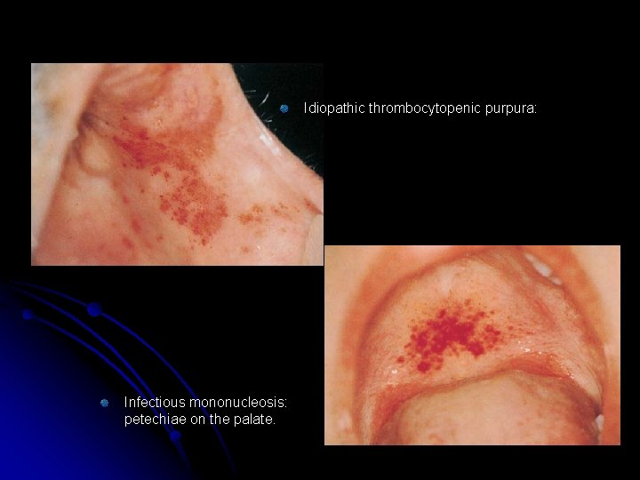Idiopathic thrombocytopenic purpura: Infectious mononucleosis: petechiae on the palate. 