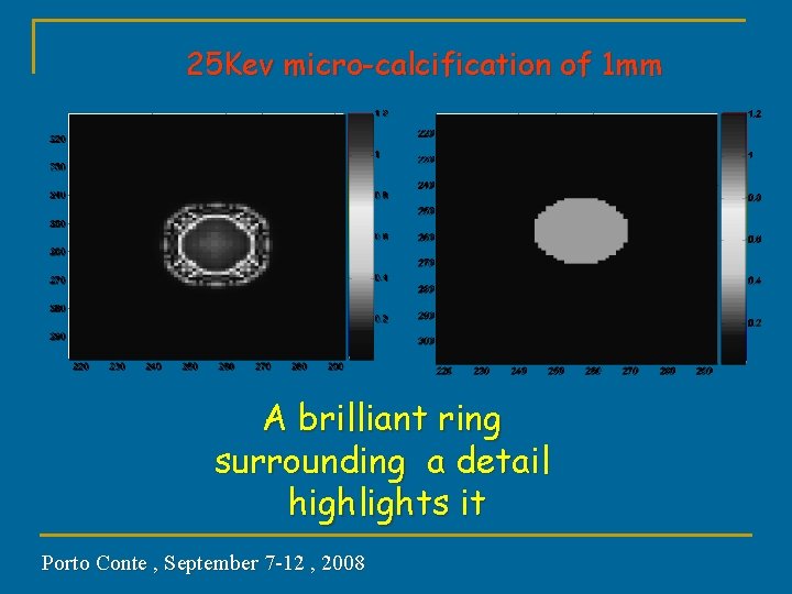 25 Kev micro-calcification of 1 mm A brilliant ring surrounding a detail highlights it
