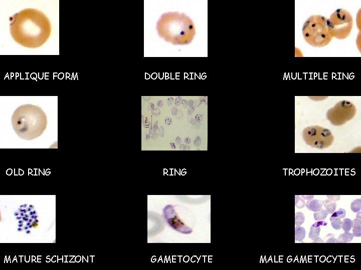 APPLIQUE FORM OLD RING MATURE SCHIZONT DOUBLE RING MULTIPLE RING TROPHOZOITES GAMETOCYTE MALE GAMETOCYTES APPLIQUE FORM OLD RING MATURE SCHIZONT DOUBLE RING MULTIPLE RING TROPHOZOITES GAMETOCYTE MALE GAMETOCYTES