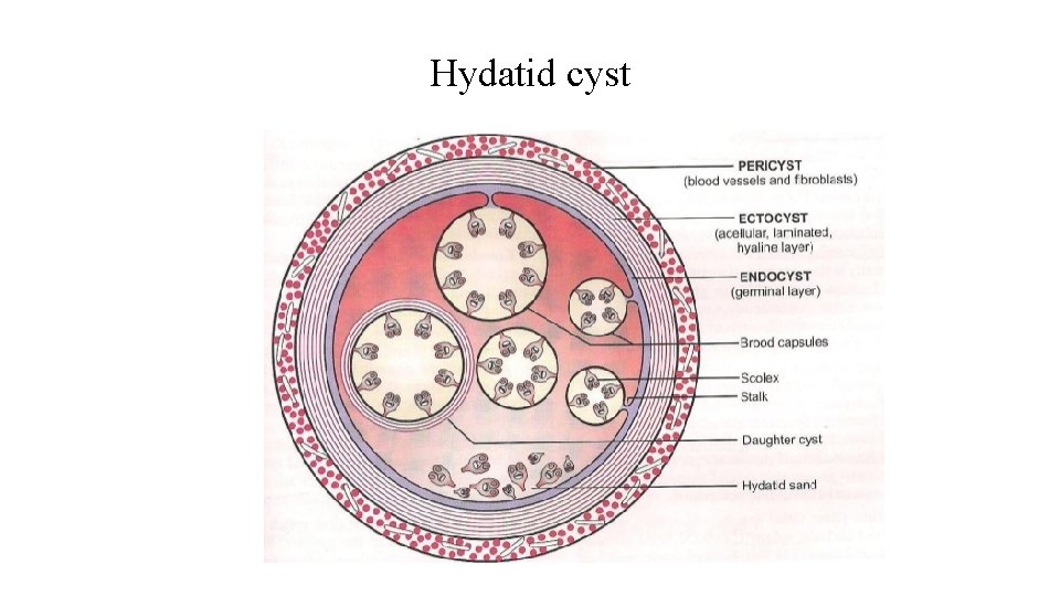 Hydatid cyst 