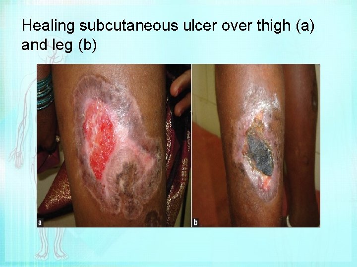 Healing subcutaneous ulcer over thigh (a) and leg (b) 