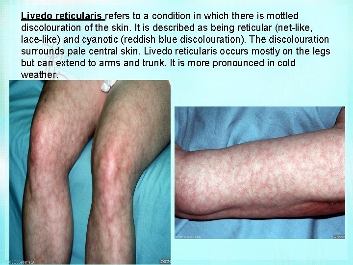 Livedo reticularis refers to a condition in which there is mottled discolouration of the