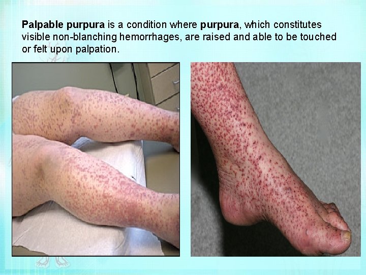 Palpable purpura is a condition where purpura, which constitutes visible non-blanching hemorrhages, are raised
