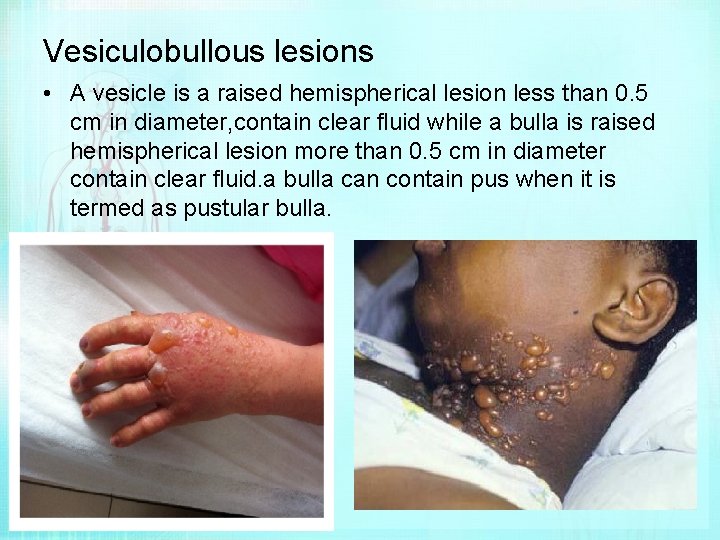 Vesiculobullous lesions • A vesicle is a raised hemispherical lesion less than 0. 5