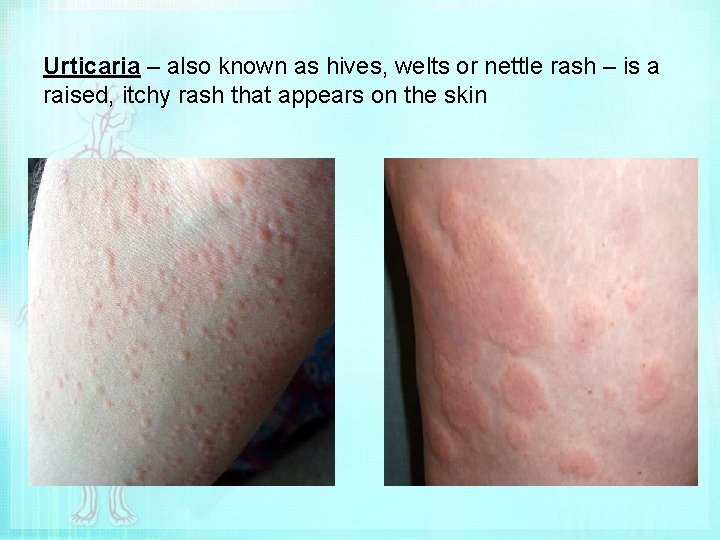Urticaria – also known as hives, welts or nettle rash – is a raised,