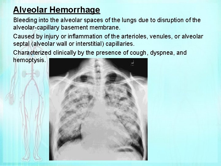Alveolar Hemorrhage Bleeding into the alveolar spaces of the lungs due to disruption of