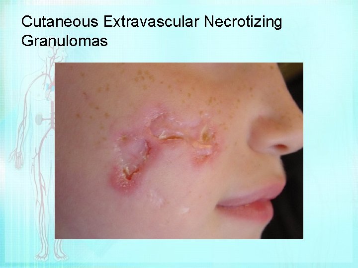 Cutaneous Extravascular Necrotizing Granulomas 