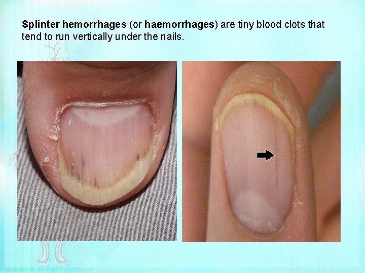 Splinter hemorrhages (or haemorrhages) are tiny blood clots that tend to run vertically under