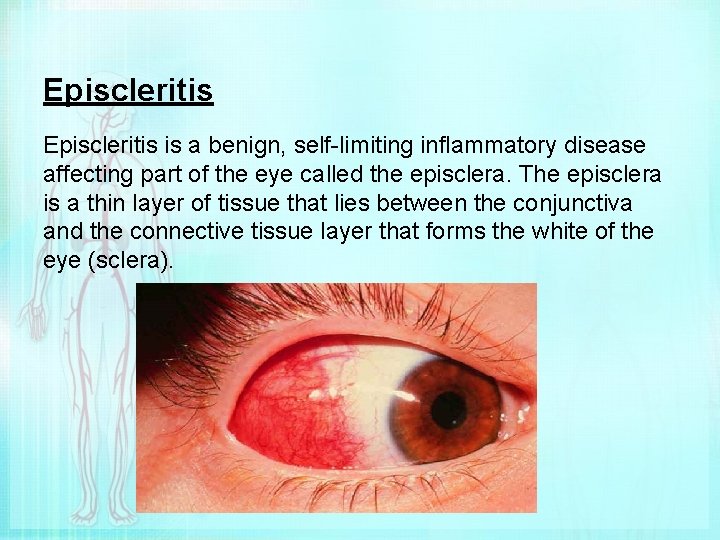Episcleritis is a benign, self-limiting inflammatory disease affecting part of the eye called the