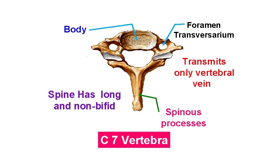 Foramen Transversarium Body Transmits only vertebral vein Spine Has long and non-bifid Spinous processes