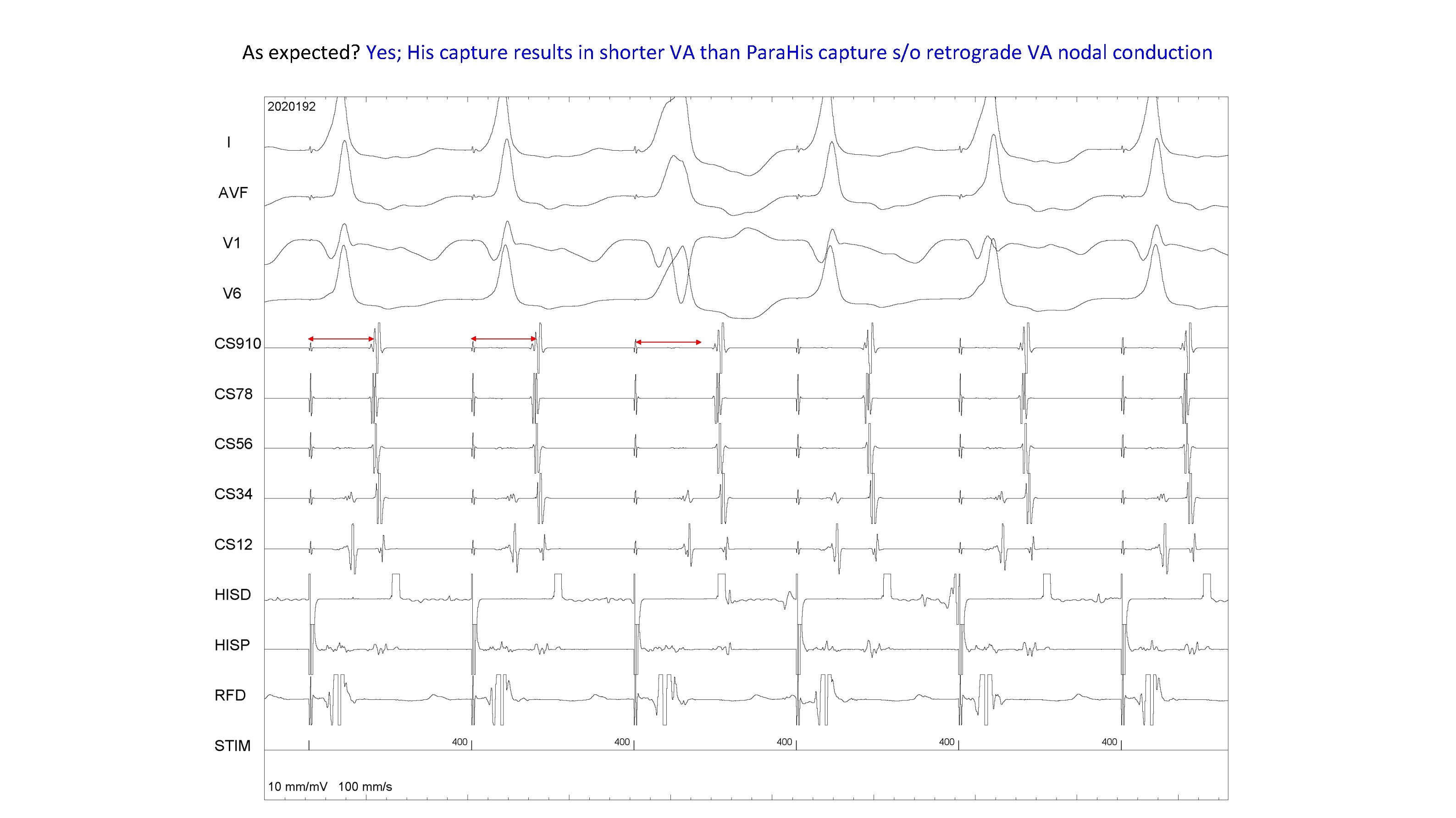 As expected? Yes; His capture results in shorter VA than Para. His capture s/o