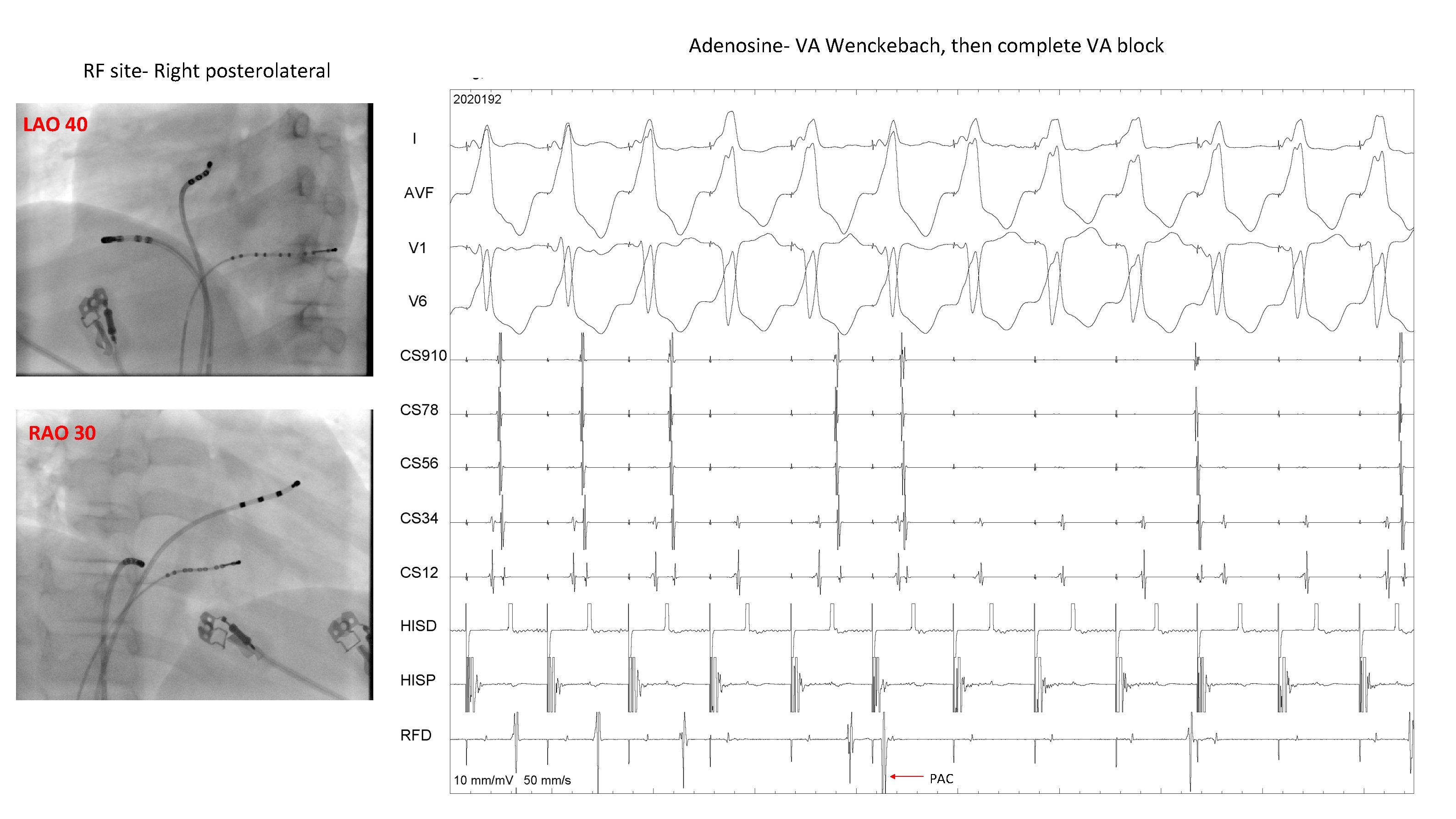RF site- Right posterolateral Adenosine- VA Wenckebach, then complete VA block LAO 40 RAO