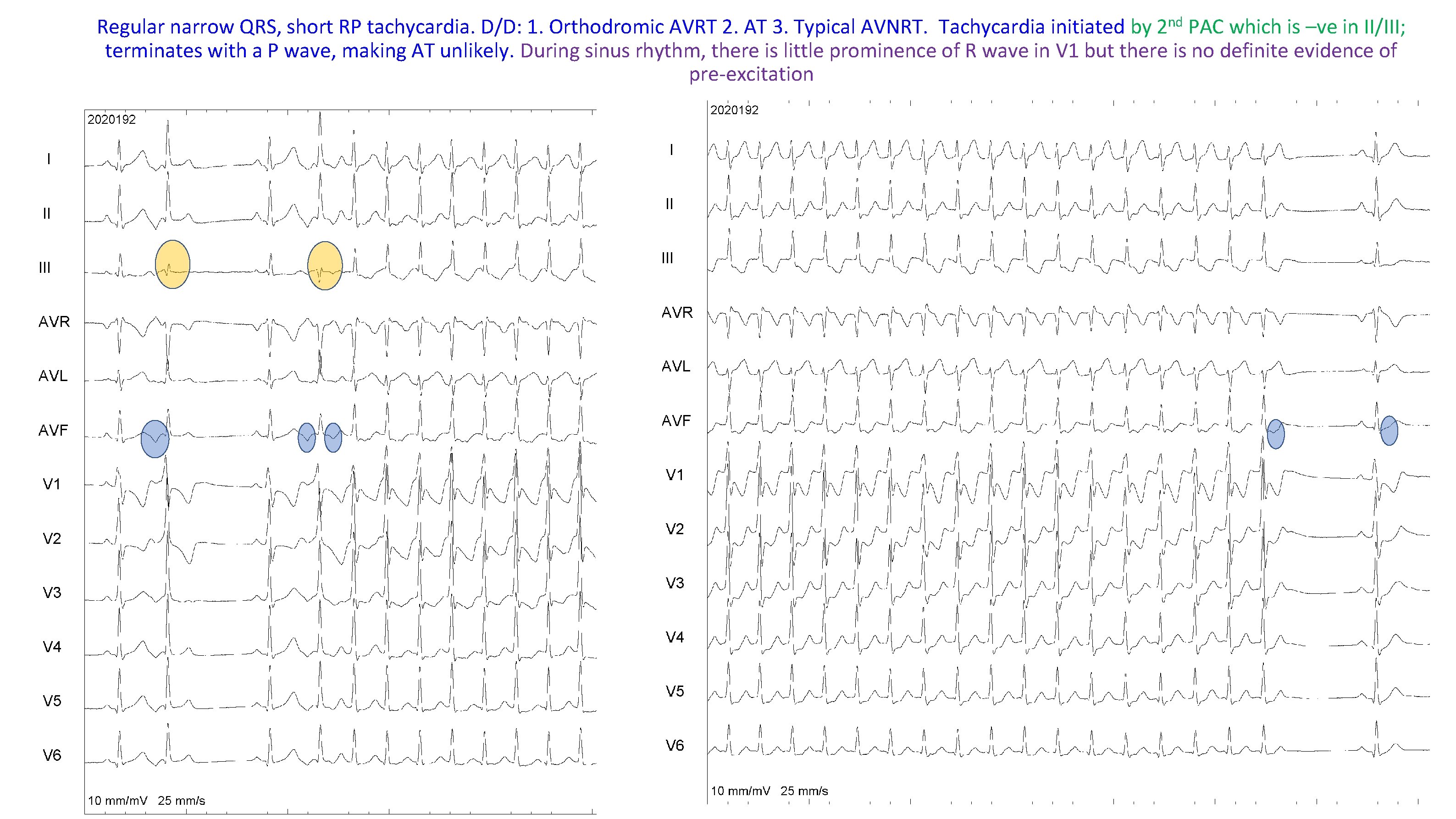 nd 2 Regular narrow QRS, short RP tachycardia. D/D: 1. Orthodromic AVRT 2. AT