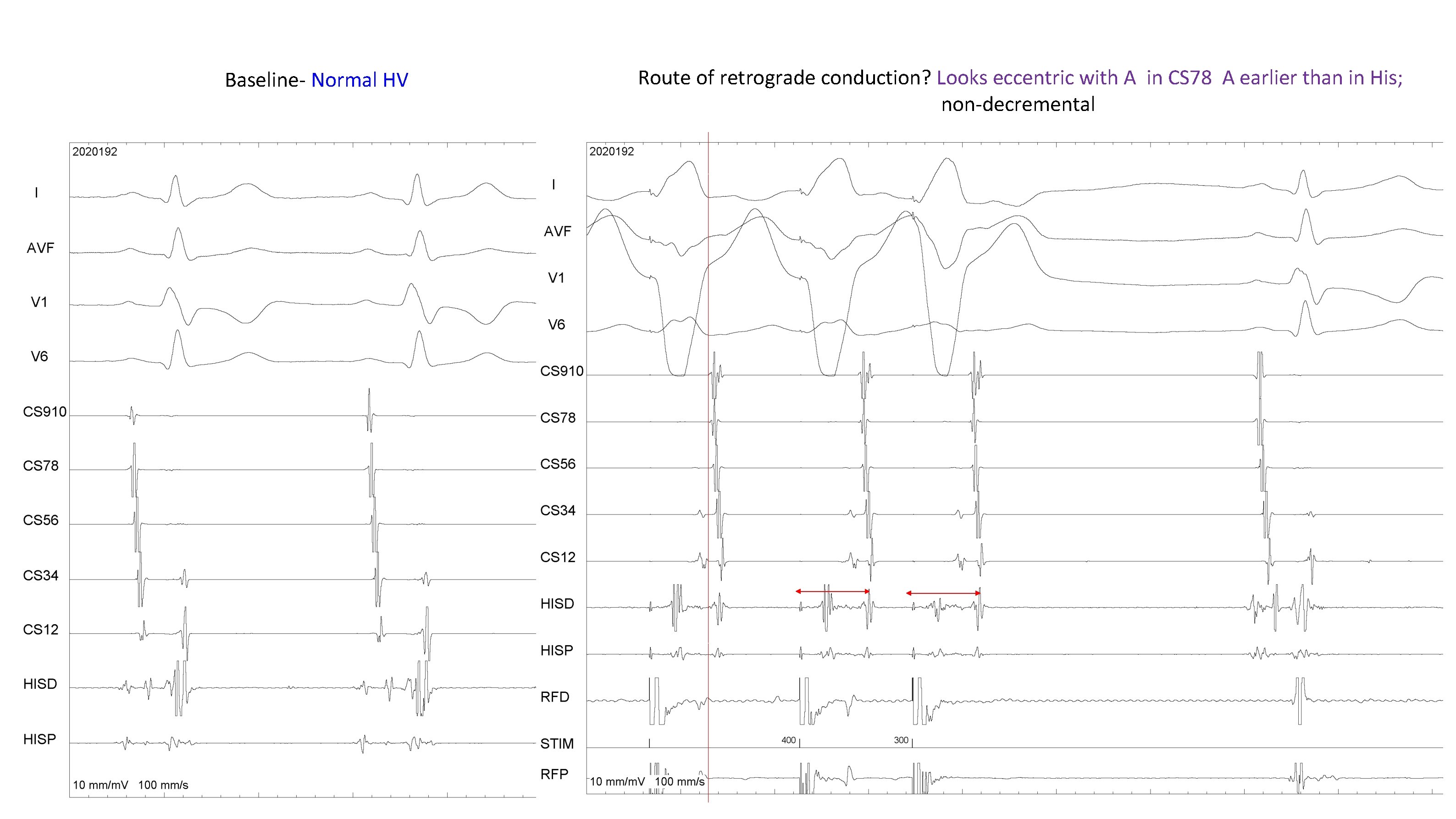 Baseline- Normal HV Route of retrograde conduction? Looks eccentric with A in CS 78