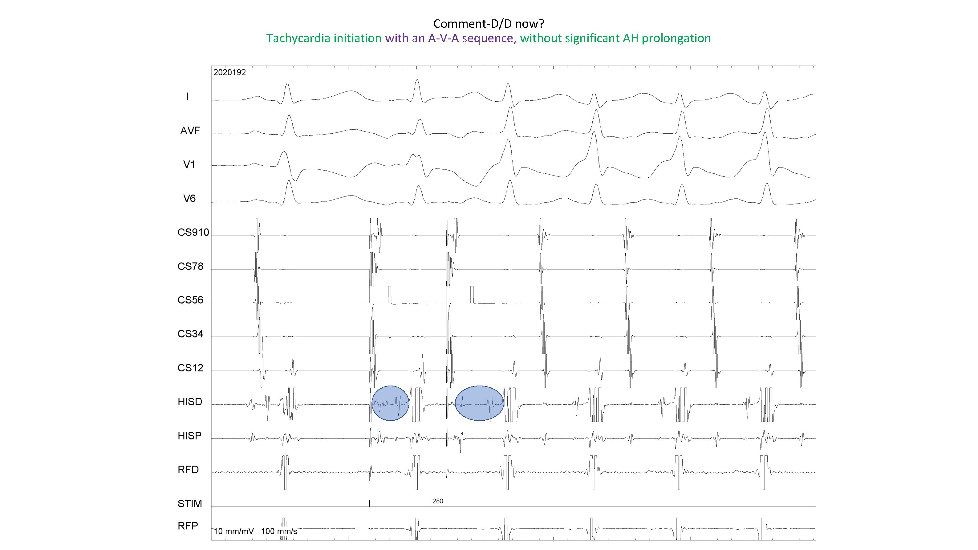 Comment-D/D now? Tachycardia initiation with an A-V-A sequence, without significant AH prolongation 