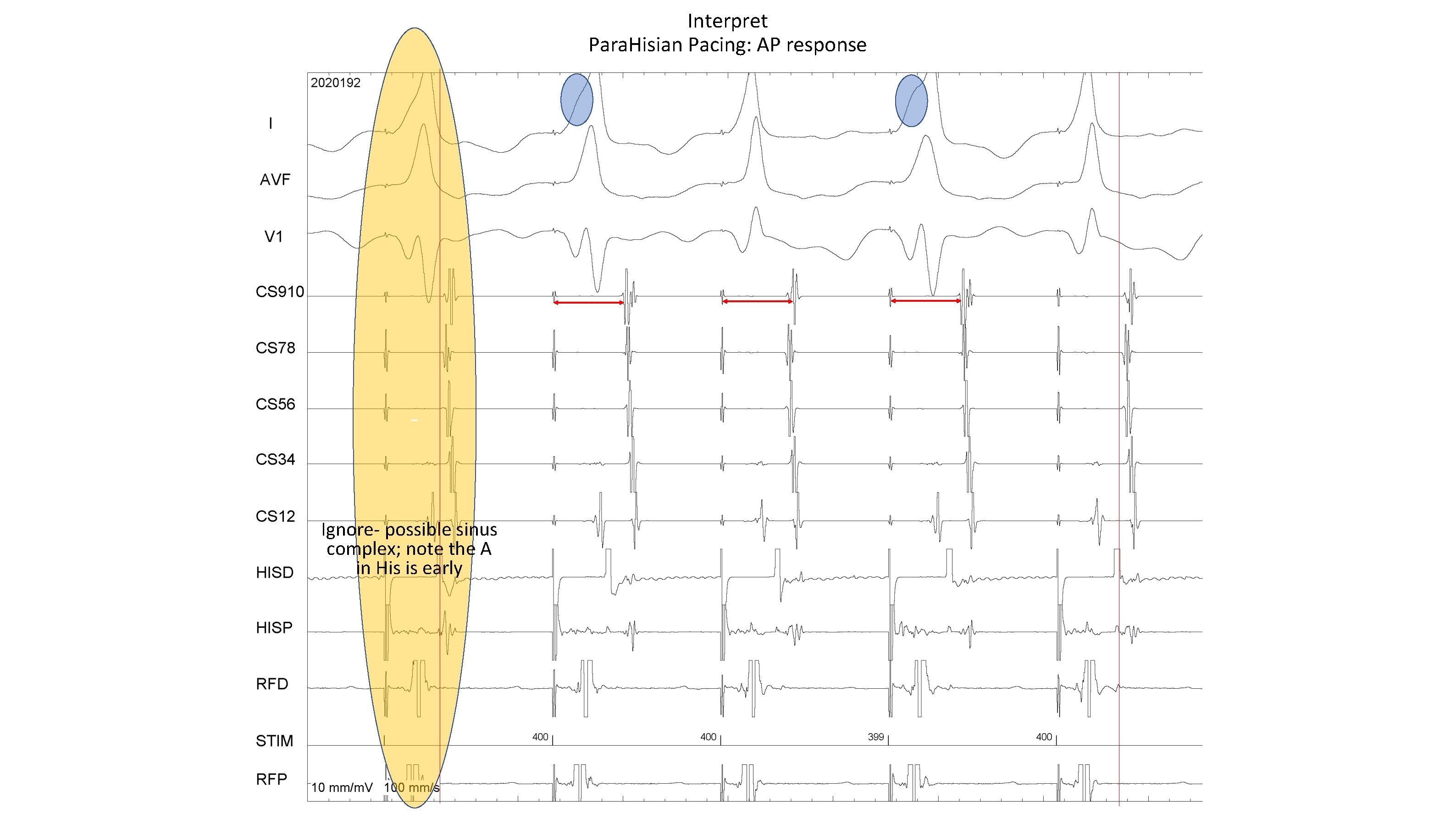 Interpret Para. Hisian Pacing: AP response - Ignore- possible sinus complex; note the A