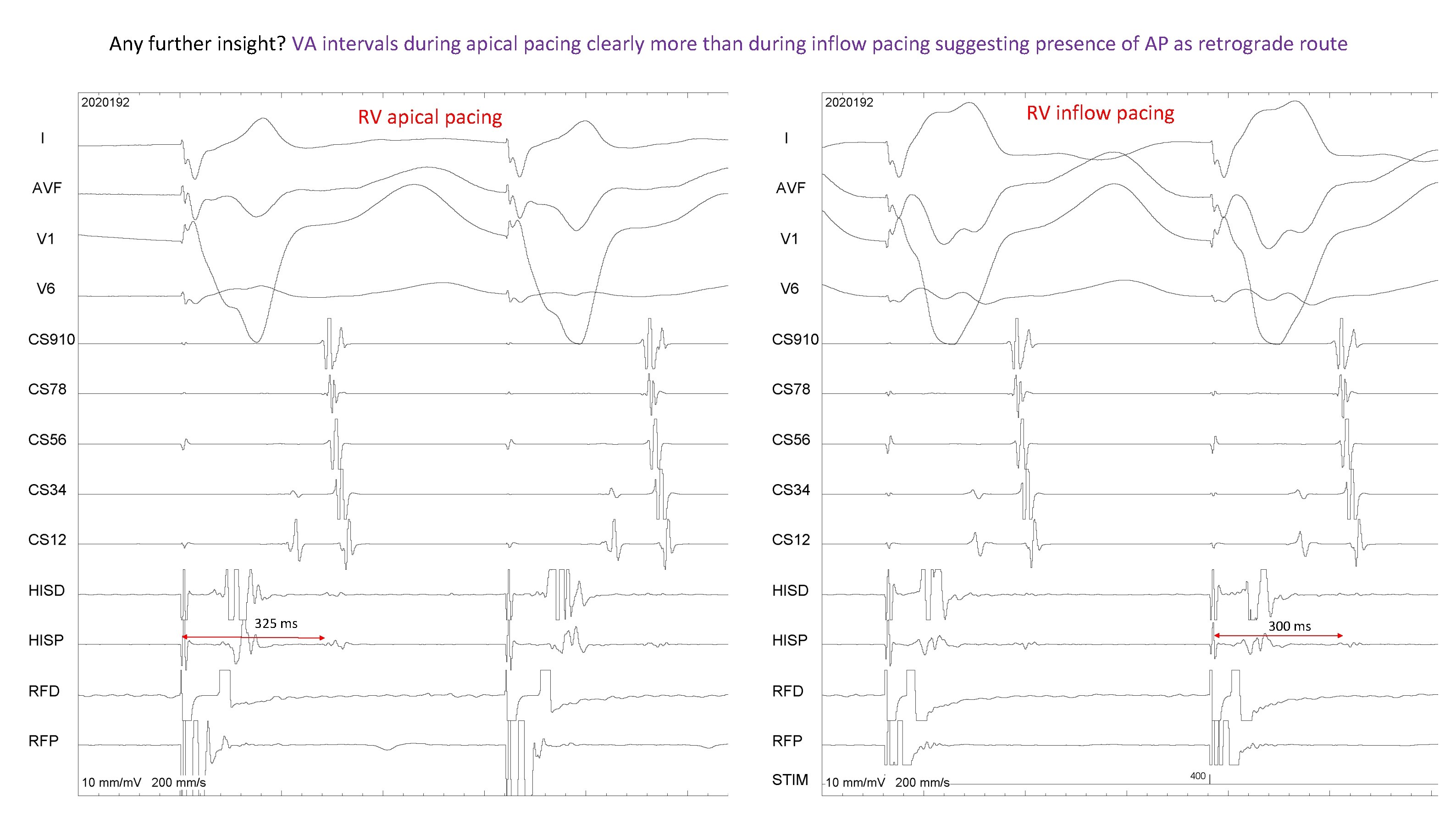 Any further insight? VA intervals during apical pacing clearly more than during inflow pacing