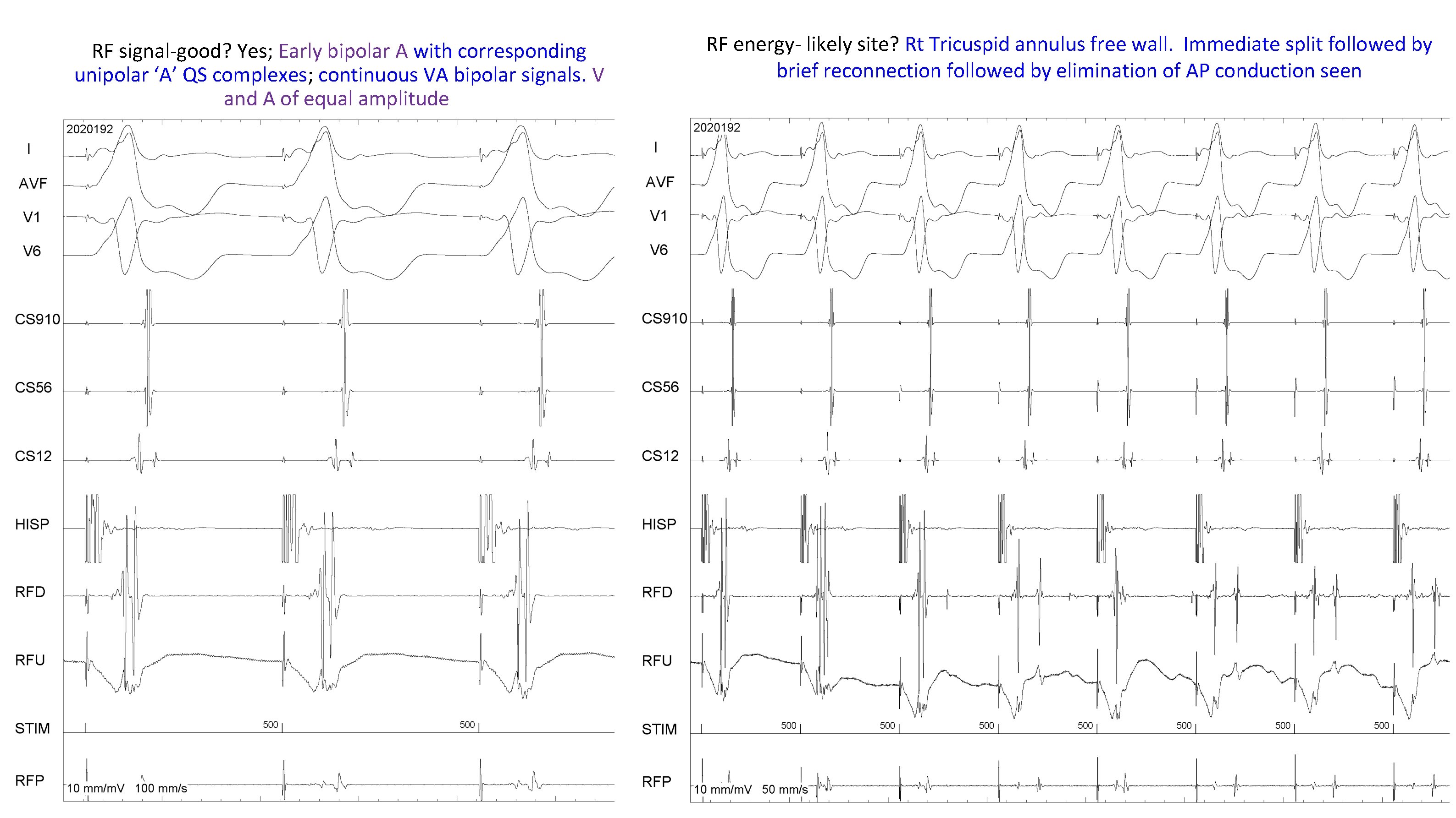 RF signal-good? Yes; Early bipolar A with corresponding unipolar ‘A’ QS complexes; continuous VA