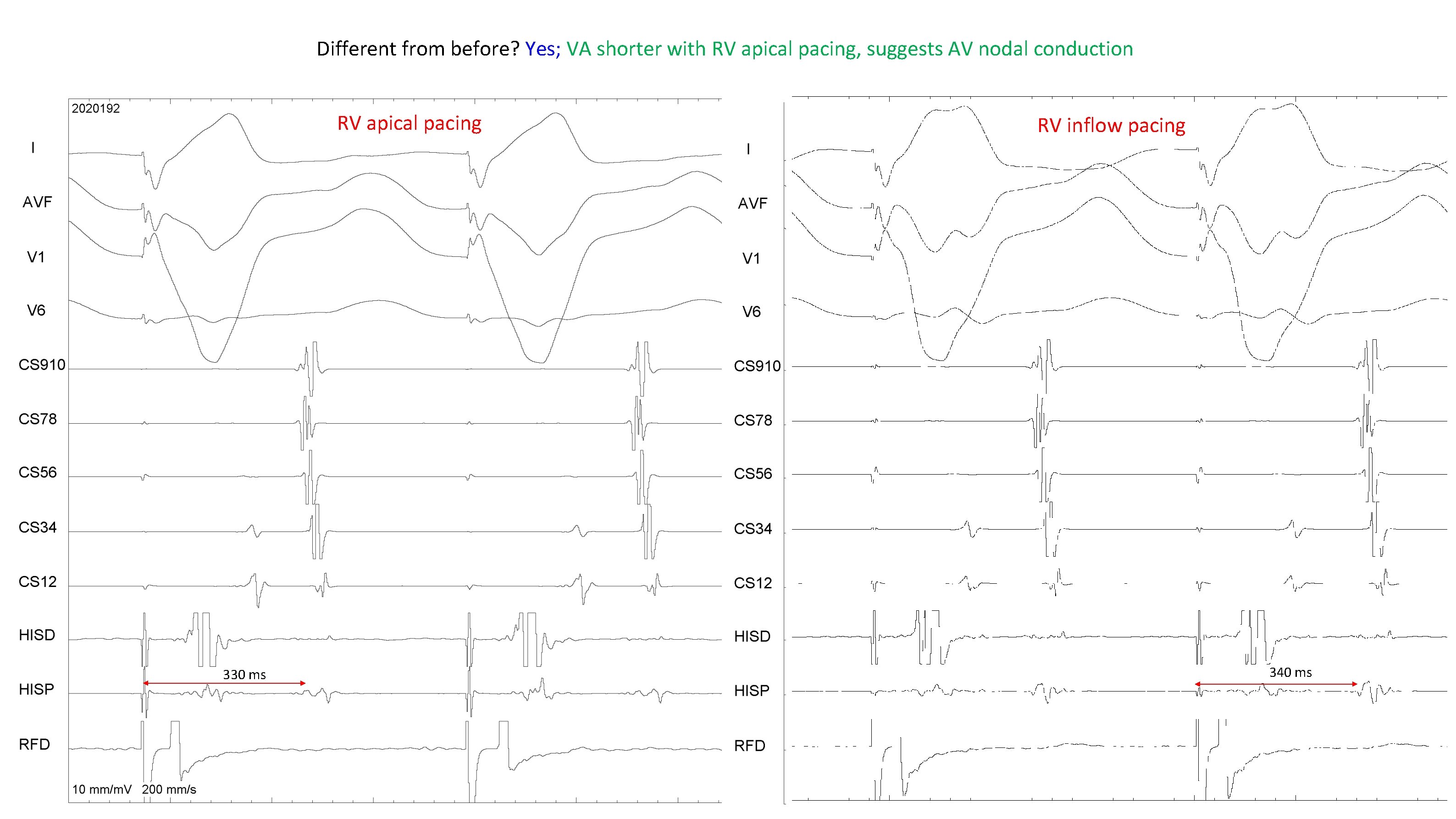 Different from before? Yes; VA shorter with RV apical pacing, suggests AV nodal conduction