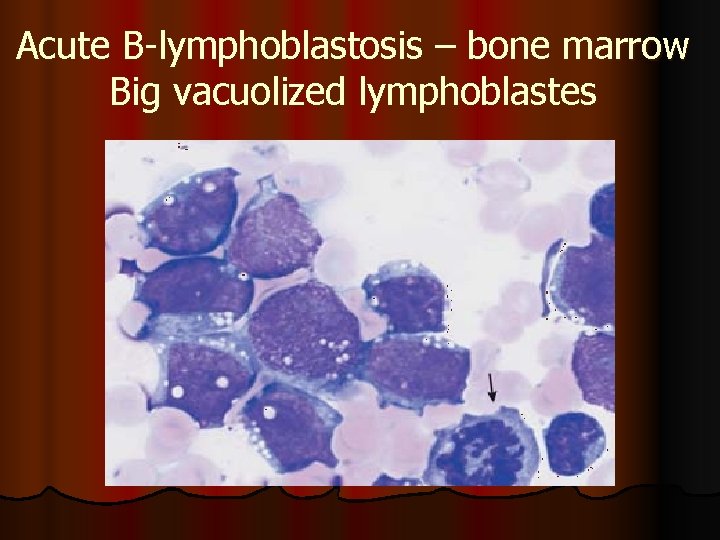 Acute В-lymphoblastosis – bone marrow Big vacuolized lymphoblastes 