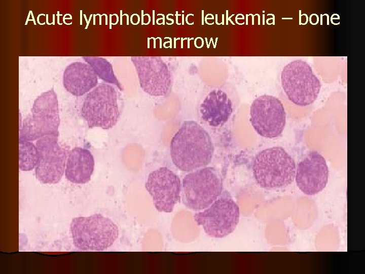 Acute lymphoblastic leukemia – bone marrrow 