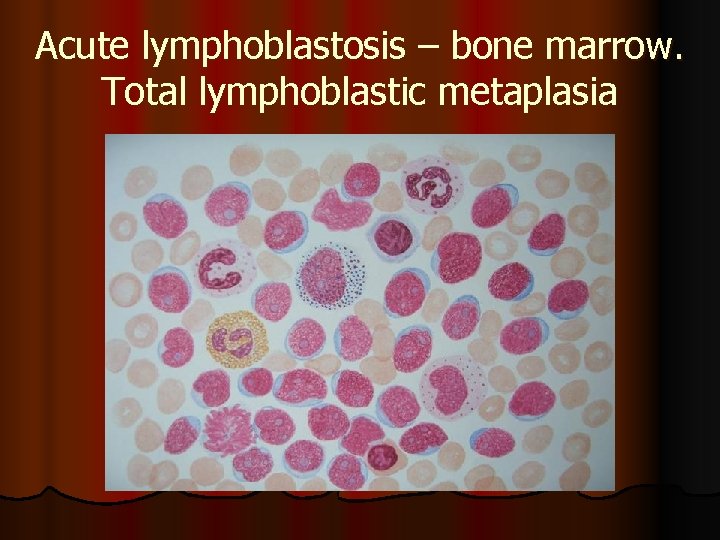 Acute lymphoblastosis – bone marrow. Total lymphoblastic metaplasia 