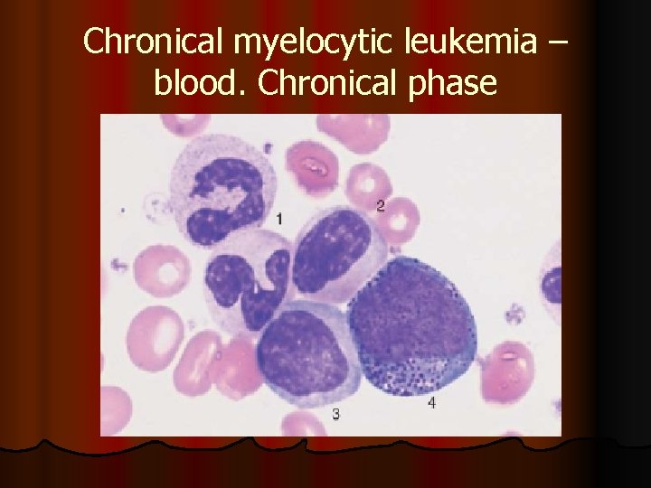 Chronical myelocytic leukemia – blood. Chronical phase 