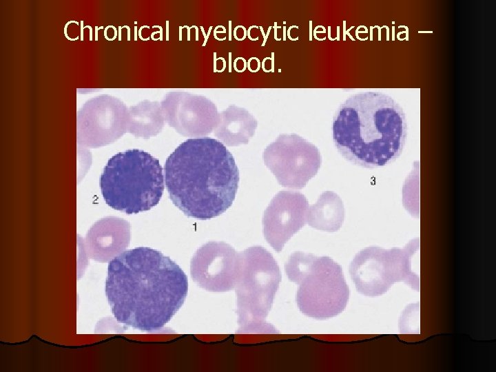 Chronical myelocytic leukemia – blood. 