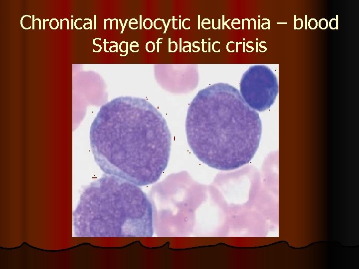 Chronical myelocytic leukemia – blood Stage of blastic crisis 
