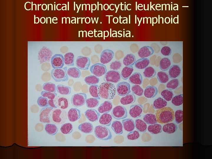Chronical lymphocytic leukemia – bone marrow. Total lymphoid metaplasia. 