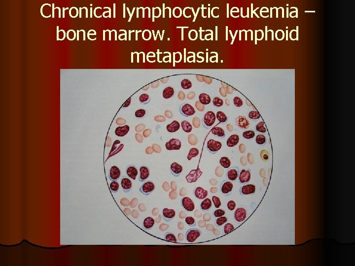 Chronical lymphocytic leukemia – bone marrow. Total lymphoid metaplasia. 