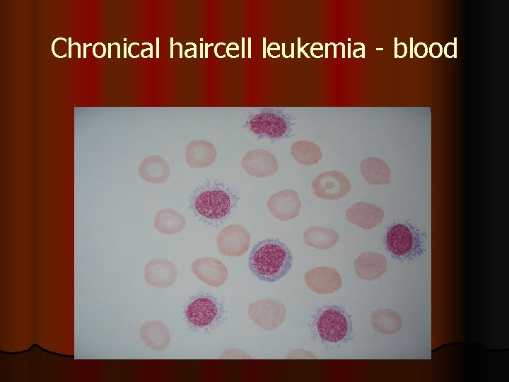 Chronical haircell leukemia - blood 