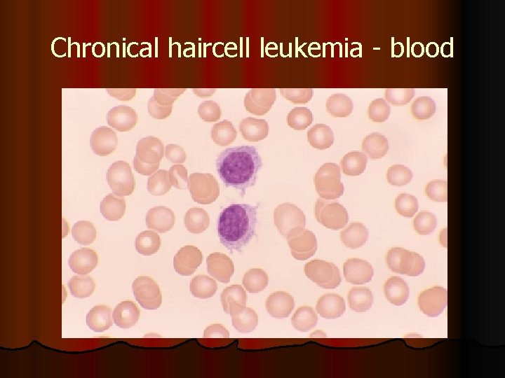 Chronical haircell leukemia - blood 